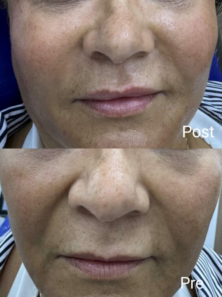 Poster knife before and after